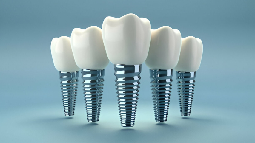 Dental Implant Aberdeen