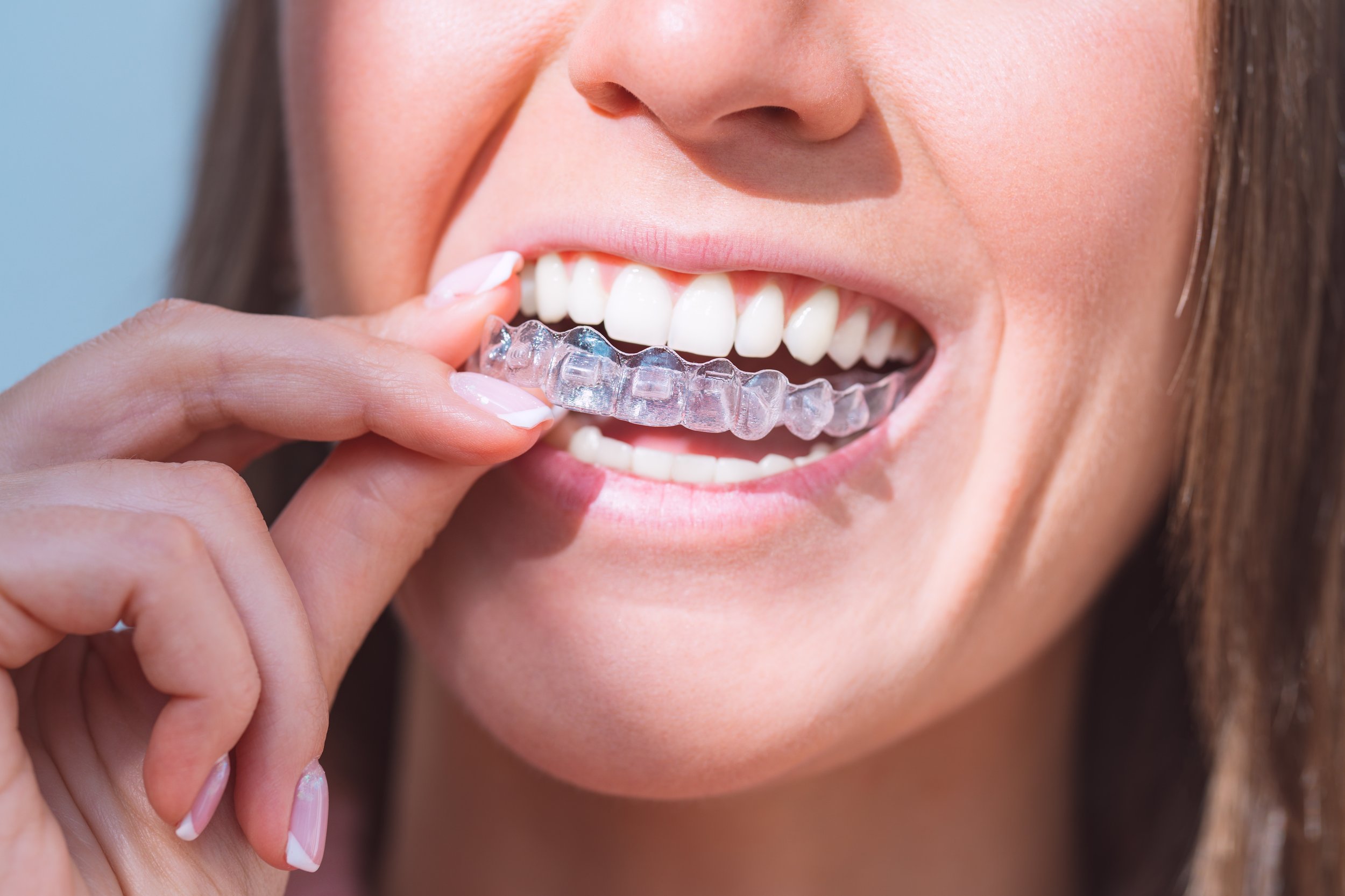 Invisalign Treatment UK