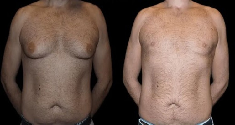 Before and After Male Breast Reduction Surgery