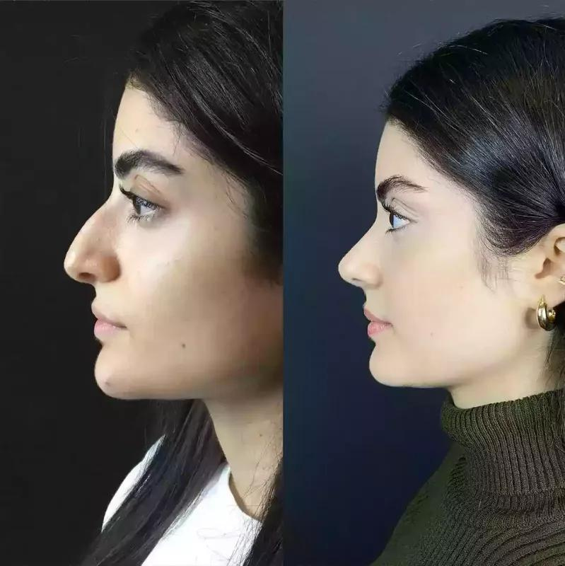 Choosing Between Open and Closed Rhinoplasty in Dubai