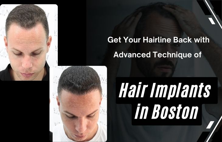 Get-Your-Hairline-Back-with-Advanced-Technique-of-Hair-Implants-in-Boston