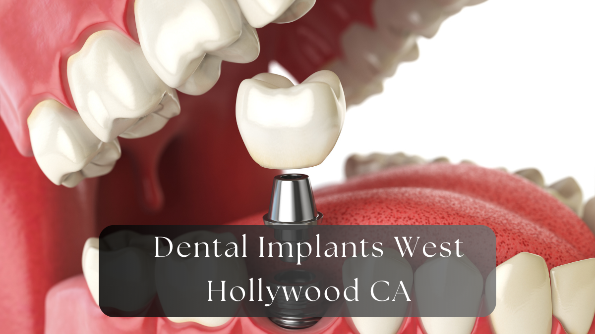 dental implants west hollywood ca