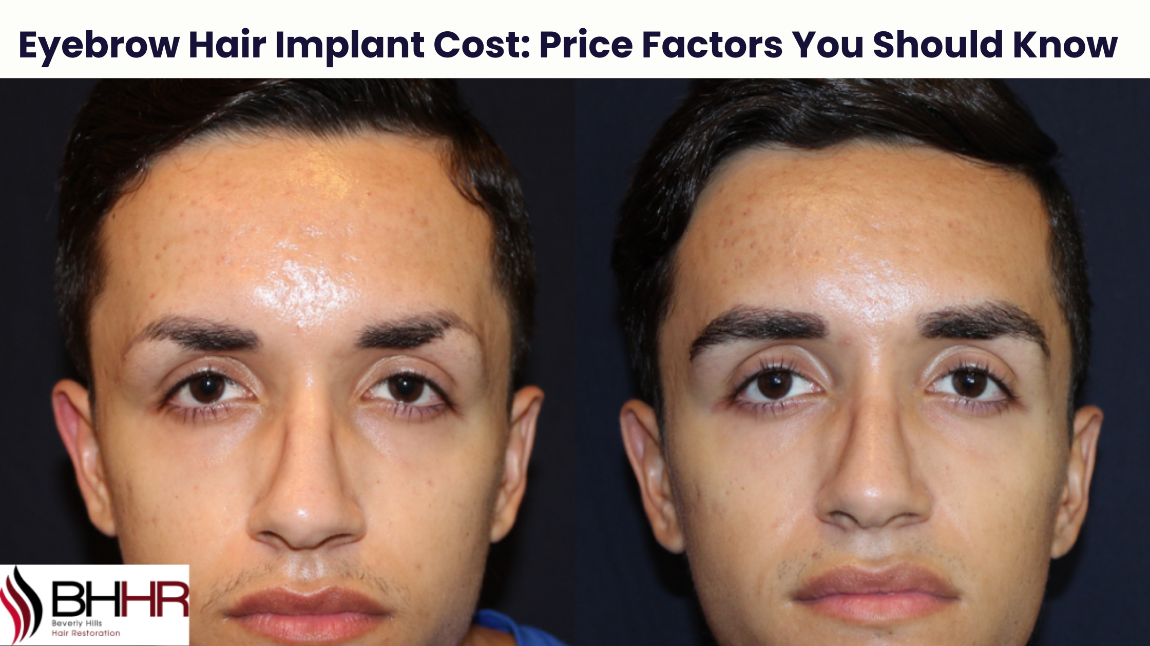 eyebrow hair implant cost