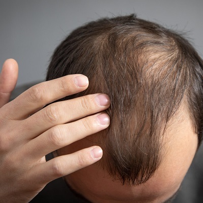 Hair Transplant in Riyadh: How Does It Work, Success Rates