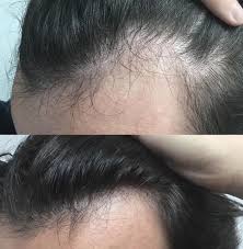 Best PRP hair treatment in Dubai