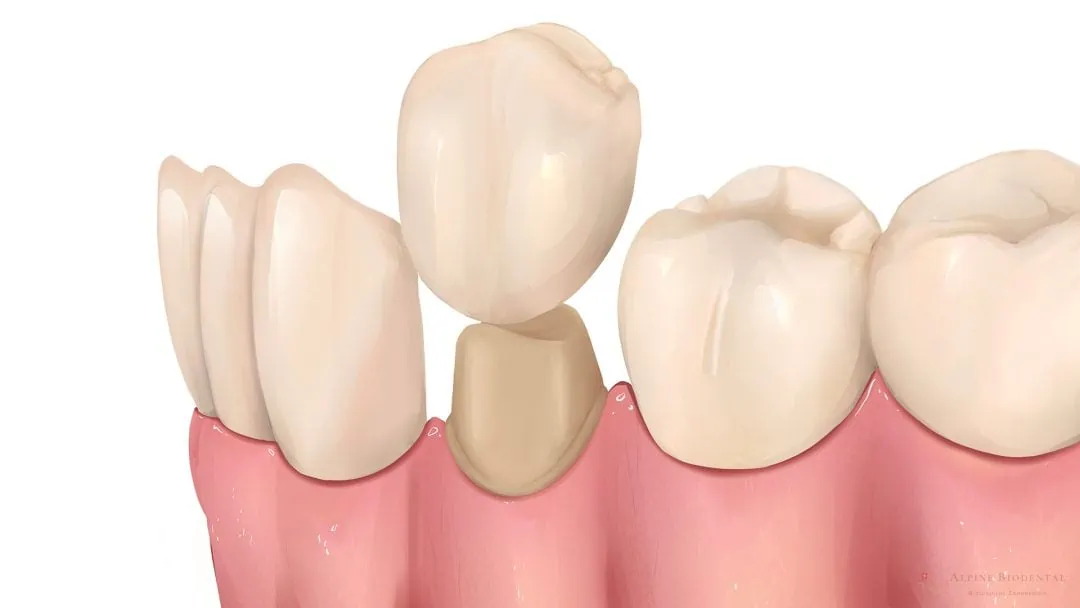 ceramic teeth cap