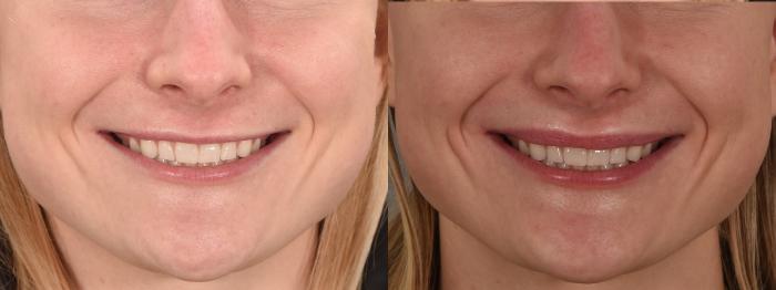 lip flip before and after