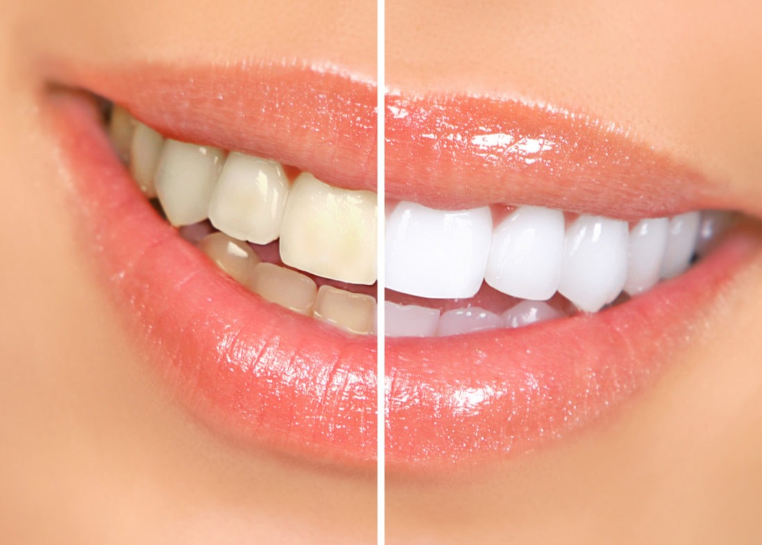 Brown Stains on Teeth
