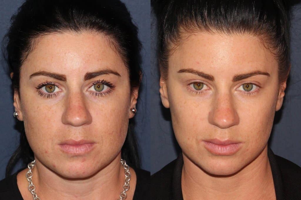 Jawline Botox Before and After Results: What Changes Can You Expect?